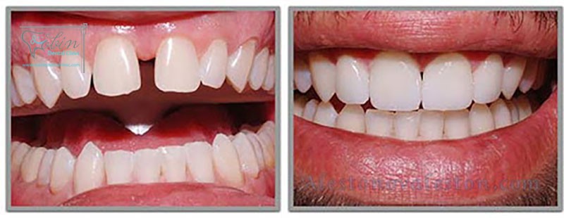 از بین بردن فاصله دندان ها با استفاده از کامپوزیت دندان